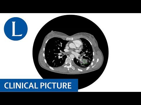 Advanced malignancy and marantic endocarditis