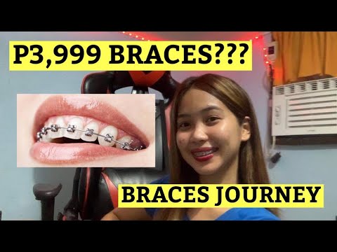 MAGKANO BA ANG MAG PA BRACES? (experiences + requirements) 2021