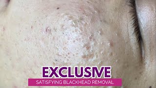 Relax Every Day With poppy tv Blackhead Removal