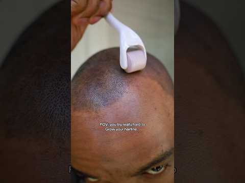 Did what I had to do… #hairtransplant