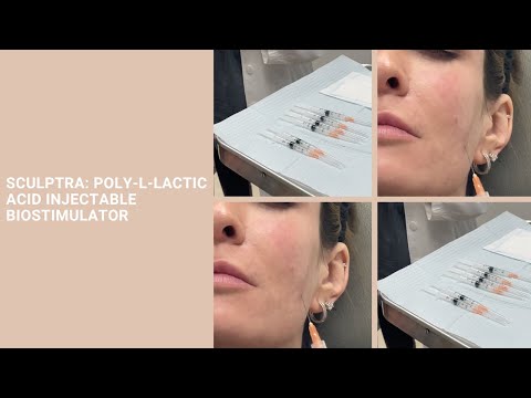 Sculptra: Poly-L-lactic Acid Injectable Biostimulator