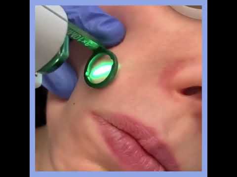 Is VBEAM right for your face? | Gendler Dermatology