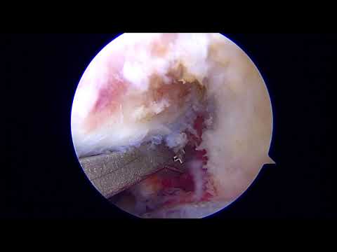 Transtibial pullout technique provides reproducible repair of meniscal root tears