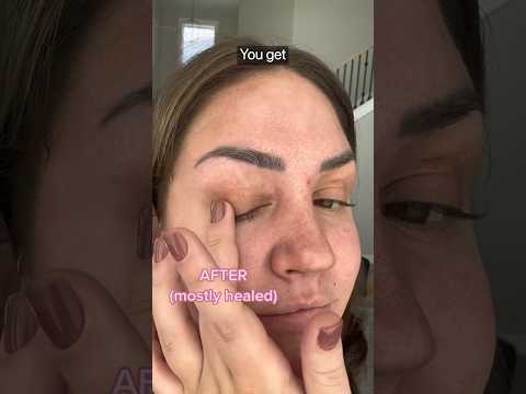 DIY Eyelid Lift - Surgeon Reacts