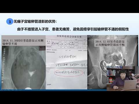 乔新荣深度教学输卵管造影之：不孕症做无痛输卵管造影查的比较准