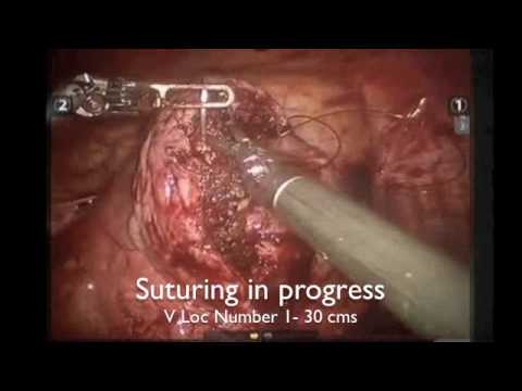 Myomectomy Hybrid technique multiple fibroid Rooma Sinha Apollo Hyderabad