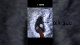 7 Weeks Pregnancy Ultrasound Scan | Wow moment #shorts #drsita #mindbodycare