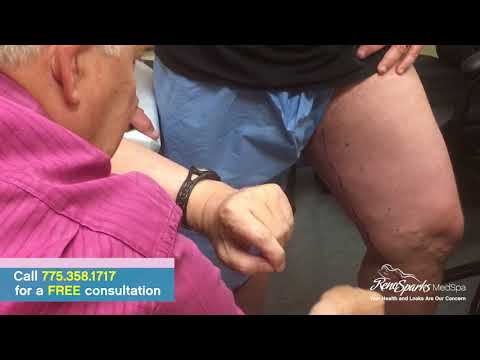 Endovenous Laser Ablation (Destruction of large varicose veins of the legs)- Reno Sparks MedSpa