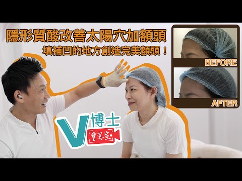 【V博士會客室】EP05（下） 隱形質酸改善太陽穴及額頭？填補凹的地方創造完美額頭✨同樣面部問題的女生可以參考一下！✨