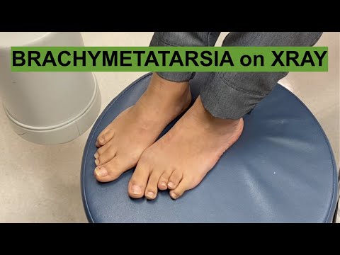 REAL PATIENTS REAL STORIES: Brachymetatarsia AKA Shortened Metatarsals in the Foot on X-Ray