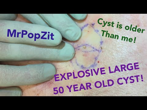 50yr old cyst filled to the top with a very brittle sac.It’s older than me but I taught it a lesson!