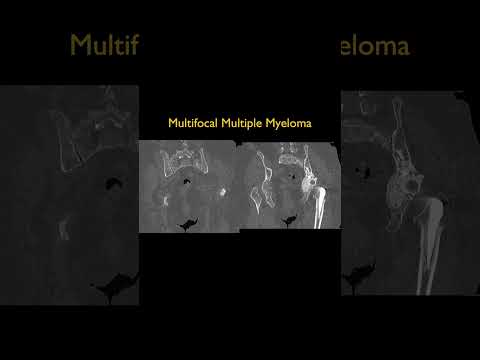 Multifocal Multiple Myeloma