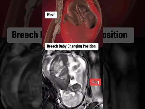 breech baby changing his position inside Womb during ultrasound scan #pregnancy #babyultrasound