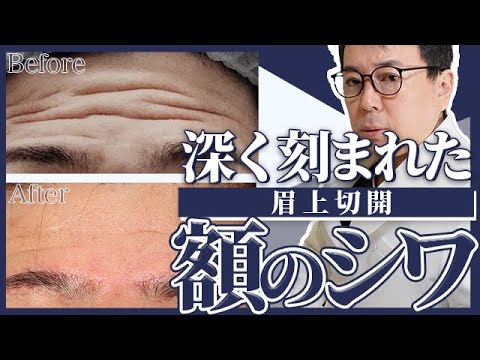 【眉上切開】深い額のシワを消す。額リフトや眉下切開との適応の違いは？傷痕は？美容外科医が徹底に解説します。