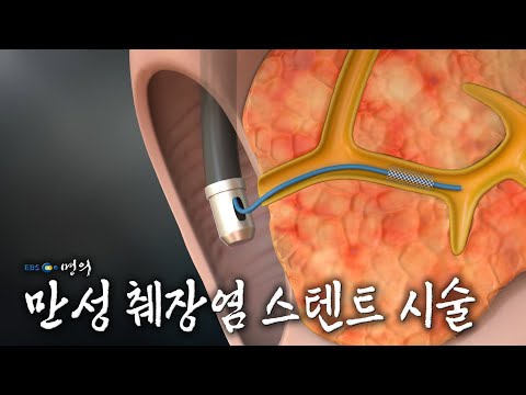 [명의 의학백과📖] 만성 췌장염 스텐트 시술