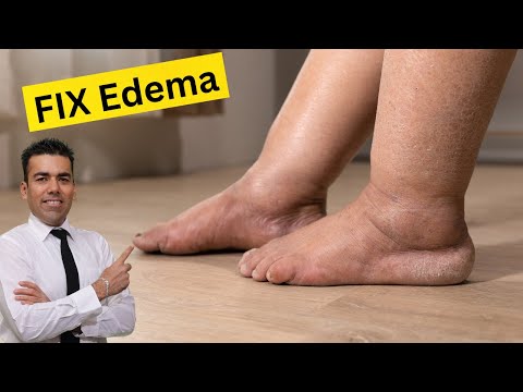 Edema! Swollen feet & legs. Root Cause, understanding and handling by Ravinder Sain. #edema