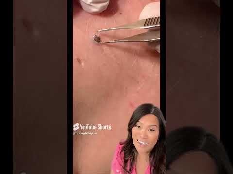 Some great blackheads and DPOWs on the back