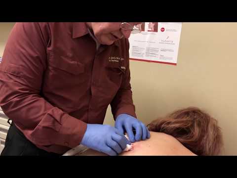 Drainage of a back abscess