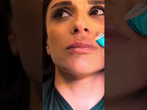 Lip filler treatment - Dr Guncel Ozturk