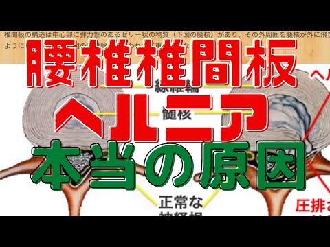 腰椎椎間板ヘルニアになる本当の原因を解説