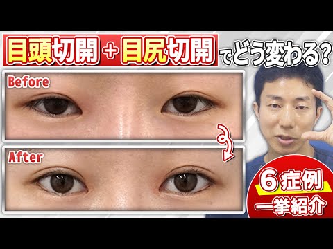 目頭切開と目尻切開の併用で目元の印象はどう変わる？症例を用いて効果と適応を解説