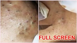 5 Years Old  Blackheads Removal - Best Pimple Popping Videos