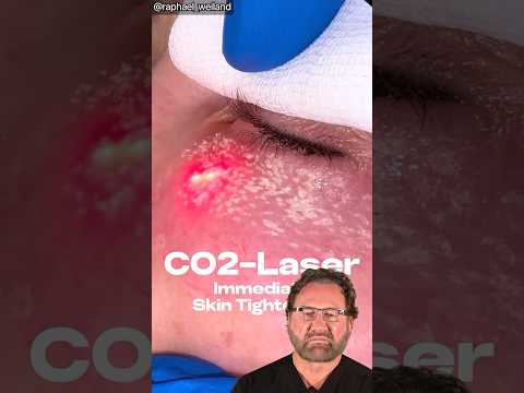 CO2 Laser IMMEDIATE Results? Surgeon Reacts