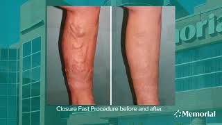 Varicose Vein Treatment with Vascular Surgeon Dr. Andrea Barker