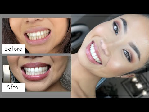 Teeth Whitening At Home With Hydrogren Peroxide 3%