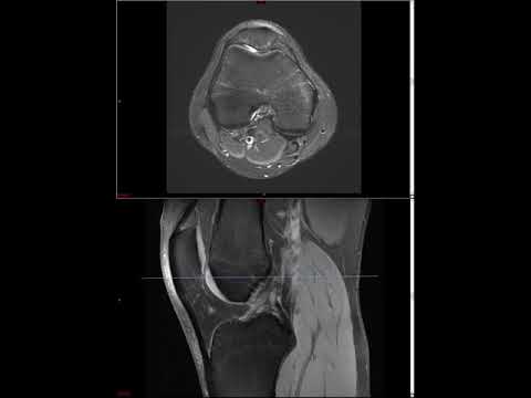 Knee MRI (Approach to MSK MRI Series)