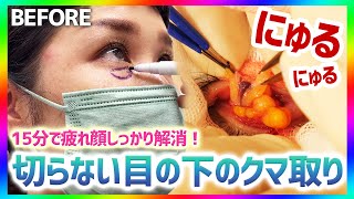 【30代必見】疲れ目解消！切らない目の下のクマ取り施術徹底解説！【クマ取り整形/脂肪取り/目の下のふくらみ/目の下のたるみ】