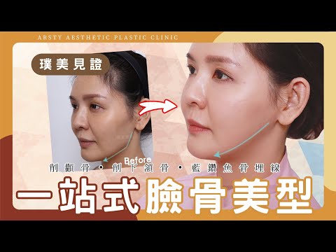 【顴骨內推、下削下頷骨、藍鑽魚骨埋線】一站式臉骨美型！ | 璞美整形外科醫美診所