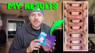 Whitebite Pro Teeth Whitening Kit Review - My 7 Day Results