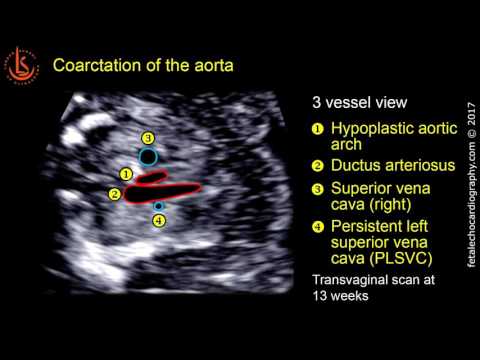 Fetal echocardiography at 11-13 weeks: Coarctation of the Aorta (CoA)