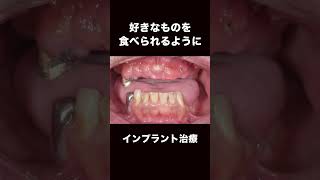 インプラント治療 #dentalclinic #インプラント #doctor #インプラント治療 #ビフォーアフター #歯並び #beforeafter #beforeandafter