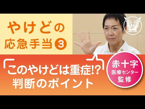 【大正健康ナビ】やけどの応急手当３　やけどの重症度を判断する