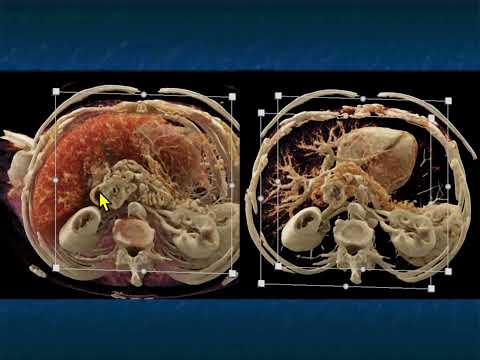 CT Evaluation of Suspected SBO: State of the Art 2024 - Part 1