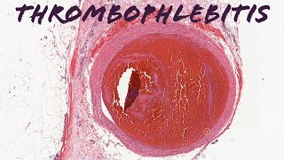 Superficial thrombophlebitis (pathology dermpath dermatology dermatopathology usmle)