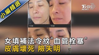 #獨家 女填補法令紋「血管栓塞」 皮膚壞死 險失明｜TVBS新聞