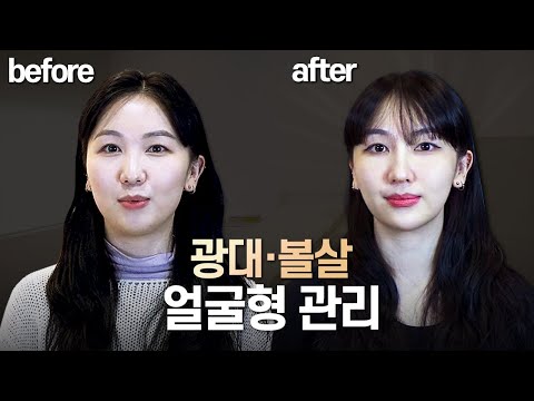 받자마자 턱선에 베여버리는 피부 시술 Top 3 │ 강남 피부과 시술 실제 경과 후기 │ 필러 시술 브이로그  코 필러 지방 분해 주사