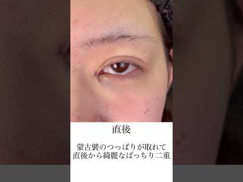 埋没二重＋目頭切開