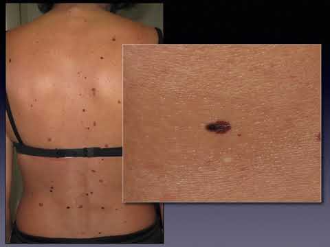 Dermoscopy for skin cancer screening - Dr. Claudio Conforti