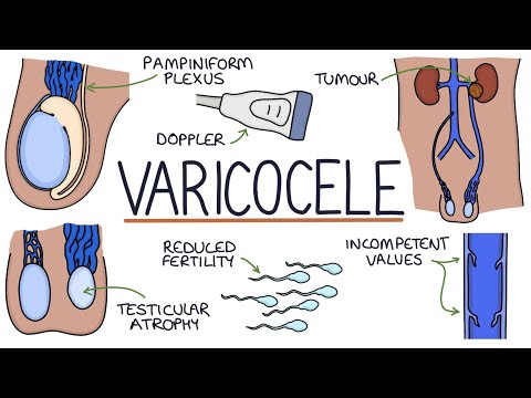 Varicoceles