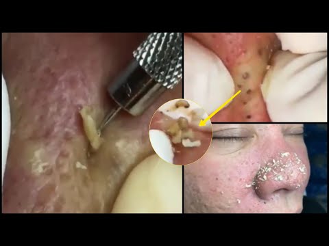 (7 Intense Blackhead Removal videos) | Poppy TV Ep#5 | viral video compilation