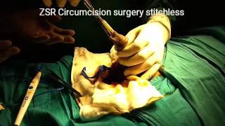 ZSR Circumcision Surgery for PHIMOSIS,Tight Foreskin by Dr.Sachin Kuber Call+919370275336