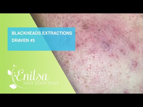 Blackheads Extractions Draven 5th Treatment