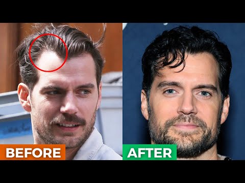 5 BRILLIANT Hairstyles To HIDE A Receding Hairline/Widows Peak