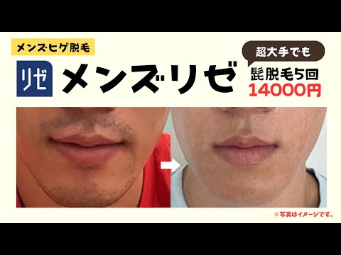 【ヤグレーザー】メンズリゼのヒゲ脱毛プランがどう考えてもお得すぎる。