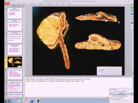 Medical School Pathology, 2013 Season, Session #32b: Endocrine-IIb