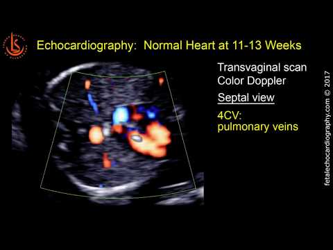 Fetal echocardiography at 11-13 weeks: Early Fetal Echo: 31 clips of Normal Hearts